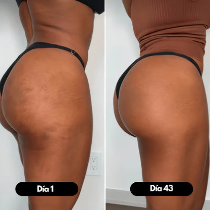 Masajeador Corporal AntiCelulitis